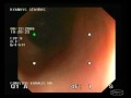 Ulcerative colitis.wmv