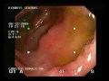 pseudomembranous colitisrash
