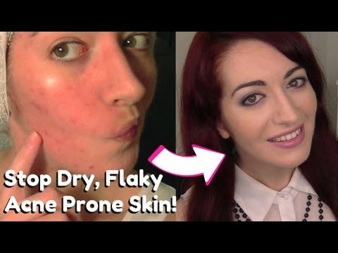 • HOW TO: Stop & Remove Dry Flaky Skin | Dry & Acne Prone Skin Care | Skin Tip Tuesday! •