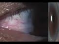 Pterygium and Arcus Senilis Pterygium and Arcus Senilis