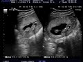 19 Week Ultrasound - Morphology Scan