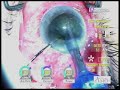 cataract surgery glaucoma tube shunt by Uday Devgan MD