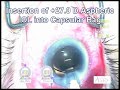 cataract surgery glaucoma tube shunt by Uday Devgan MD cataract surgery glaucoma tube shunt by Uday Devgan MD