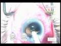 Glaucoma And Cataract Surgery Glaucoma And Cataract Surgery