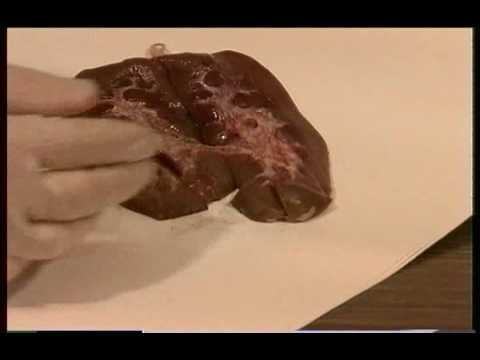 how to drain prostate gland video