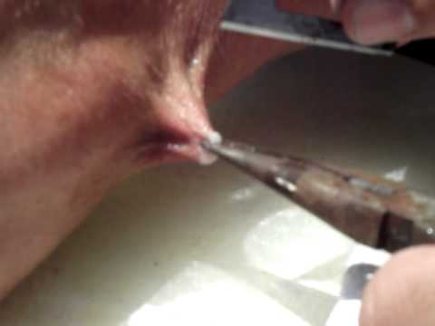 verrugas genitales en hombres team6cause