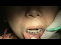 Lower anterior orthodontic anchor placement, part 1, incision, pilot hole