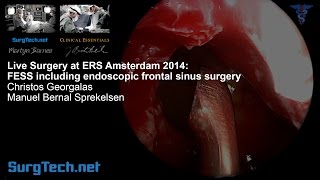 SurgTech FESS including endoscopic frontal sinus surgery (Georgalas/Sprekelsen)