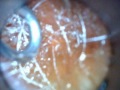 Wax Removal - Tinnitus and sudden Hearing Loss