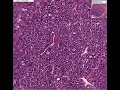 Histopathology Thyroid --Follicular adenoma (microfollicular Histopathology Thyroid --Follicular adenoma (microfollicular