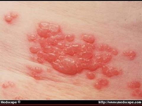 zoster - Shingles, also called Herpes Zoster, is a painful, blistering rash. And while it's contagious, you'll be very surprised to find out what you can catch from i...