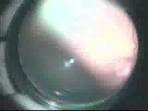 Retinopathy of prematurity