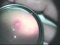 Sudhalkar Eye Hospital presentation of ROP by Indirect Ophth Retinopathy of Prematurity