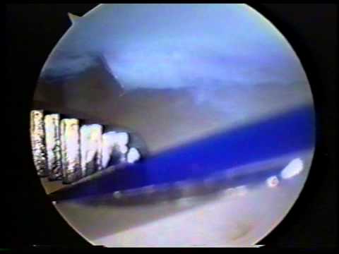 how to repair tfcc tear