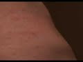 Alergic Reaction to Penicillin