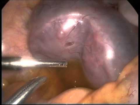 how to treat mild ohss