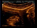Ecografia 12 semanas Ecografia 12 semanas