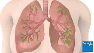 How do doctors treat lung disease caught at an early stage?