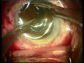 Keratoprosthesis
