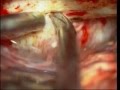 Brain tumor-trigeminal schwannoma-microsurgery-dr suresh dugani/HUBLI/INDIA