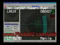 Ian del Carmen gets LASIK Surgery - Real-Time LASIK Process
