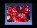 Combined transmastoid middle fossa approach for giant cholesterol granuloma of the petrous apex