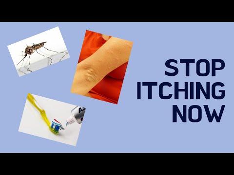 how to relieve itching from gnat bites