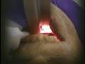 Carina Visible during Direct Laryngoscopy