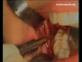 мудрости удаление зуба (www.oralcamera.net/ru)