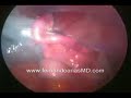 APENDICECTOMIA LAPAROSCOPICA APENDICECTOMIA LAPAROSCOPICA