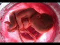 aborto stop abortion