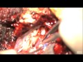 Vestibular schwannoma: suboccipital approach