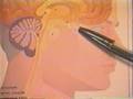 Cushing's Disease-Pituitary Brain Tumor