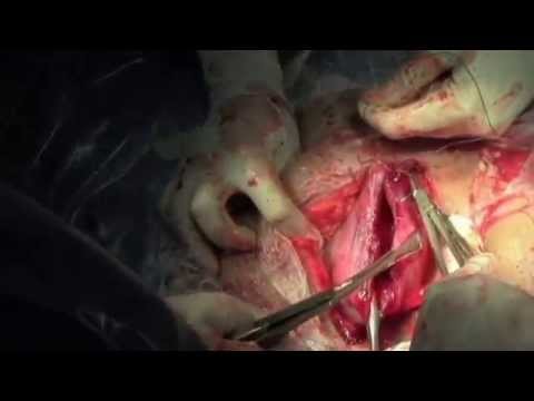how to get rid of your c section scar