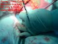 cesarean 1