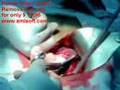 cesarean 1