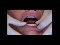 All-Wire-Retainer-in