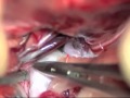 Application Of The Yaşargil T-Bar Clip For Aneurysm Treatment Application Of The Yaşargil T-Bar Clip For Aneurysm Treatment