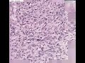 Histopathology&nbsp;Brain--&nbsp;Glioblastoma&nbsp;multiforme