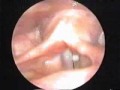 Quiste Cuerda Vocal - Videoestroboscop�a lar�ngea