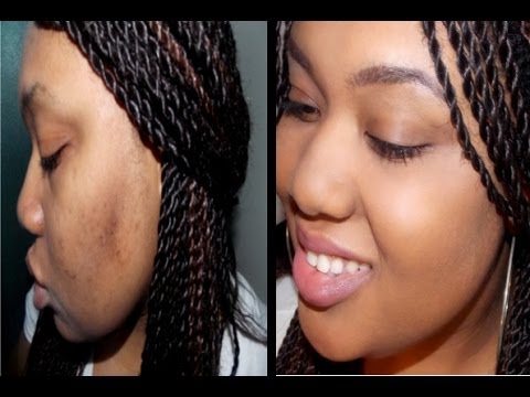 how to cover up acne scars