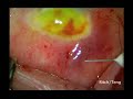 Transconjunctival Needle Revision Avastin TCNR OU