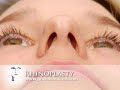 Rhinoplasty (Nose Job) at www.PearsonFaces.com