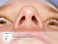 Rhinoplasty (Nose Job) at www.PearsonFaces.com