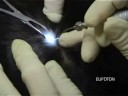 Treatment of sebaceous cyst with LASEmaR 800