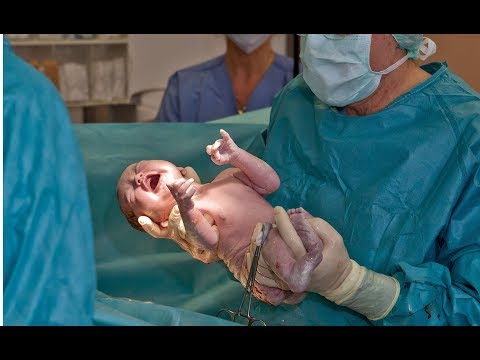 Geburten: Immer mehr Kinder kommen per Kaiserschnitt zur Welt