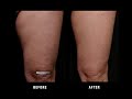 Cellulite Reduction