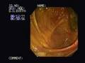Colonoscopy