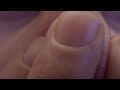 Huge Blackheads on nose popped. Extreme close up!