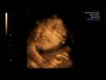 ultrasonografia 4D